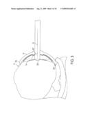 Bone Resurfacing System and Method diagram and image