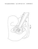 Bone Resurfacing System and Method diagram and image