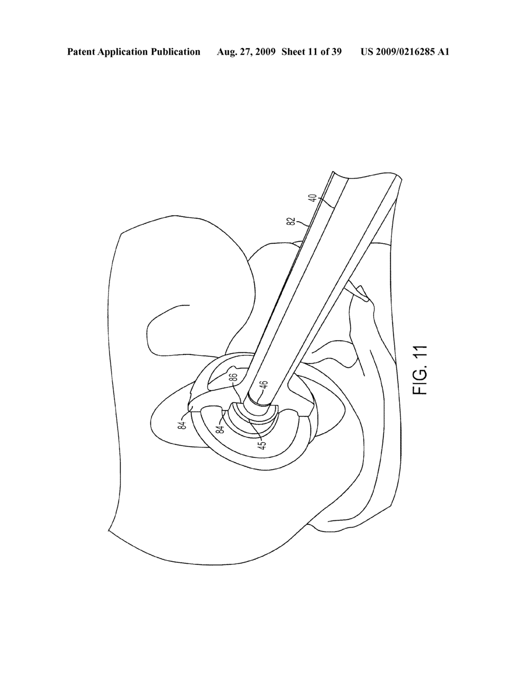 Bone Resurfacing System and Method - diagram, schematic, and image 12