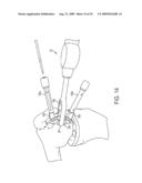 Bone Resurfacing System and Method diagram and image