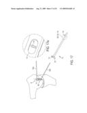 Bone Resurfacing System and Method diagram and image