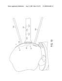 Bone Resurfacing System and Method diagram and image