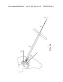 Bone Resurfacing System and Method diagram and image