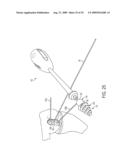 Bone Resurfacing System and Method diagram and image