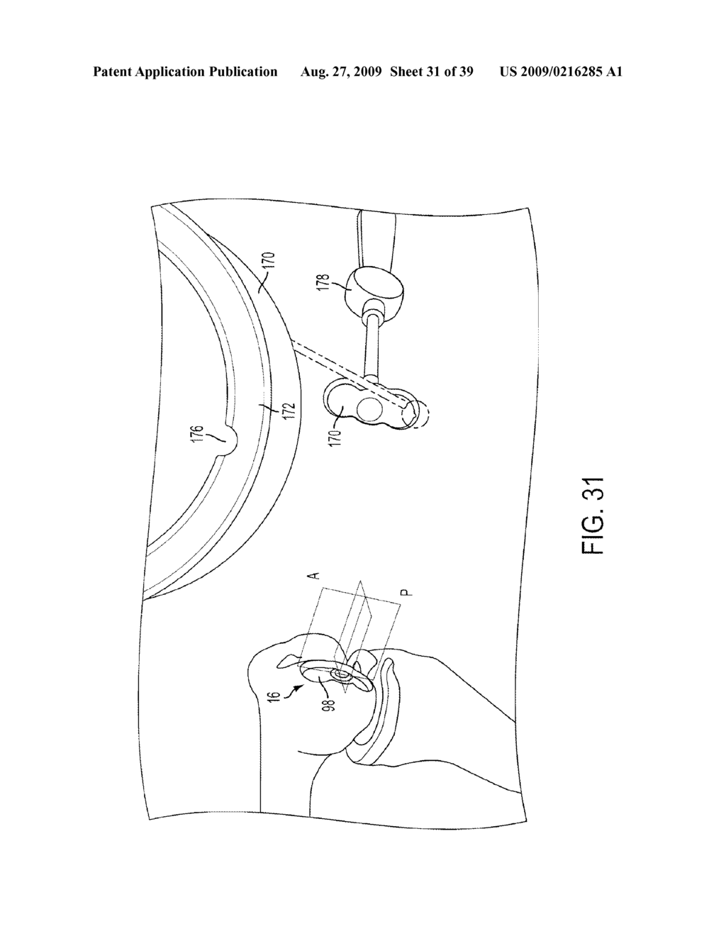 Bone Resurfacing System and Method - diagram, schematic, and image 32