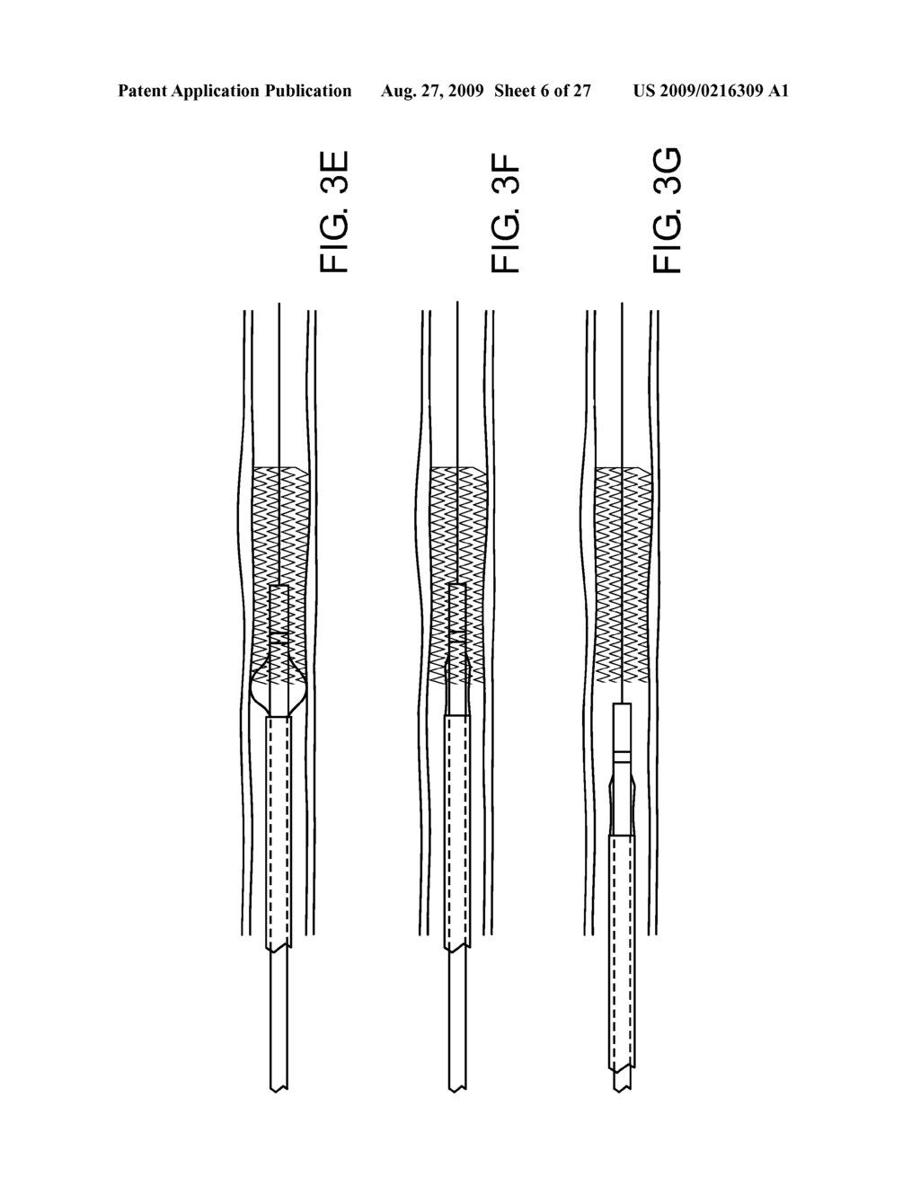 CONFORMABLE VASCULAR PROSTHESIS DELIVERY SYSTEM - diagram, schematic, and image 07