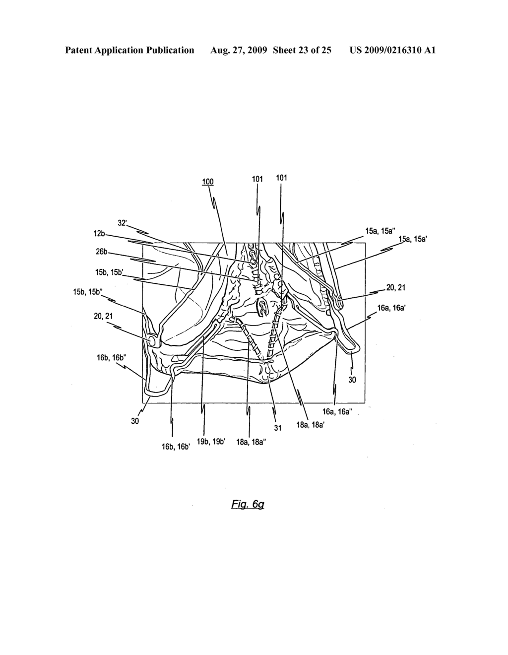 Stent for the positioning and anchoring of a valvular prosthesis in an implantation site in the heart of a patient - diagram, schematic, and image 24