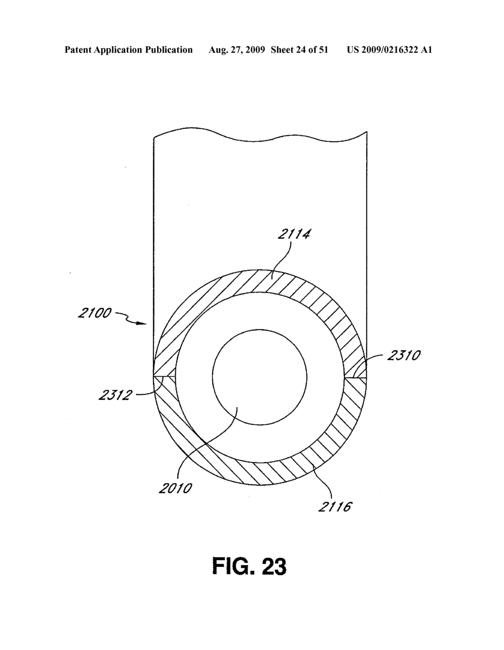 ADJUSTABLE ANNULOPLASTY RING AND ACTIVATION SYSTEM - diagram, schematic, and image 25