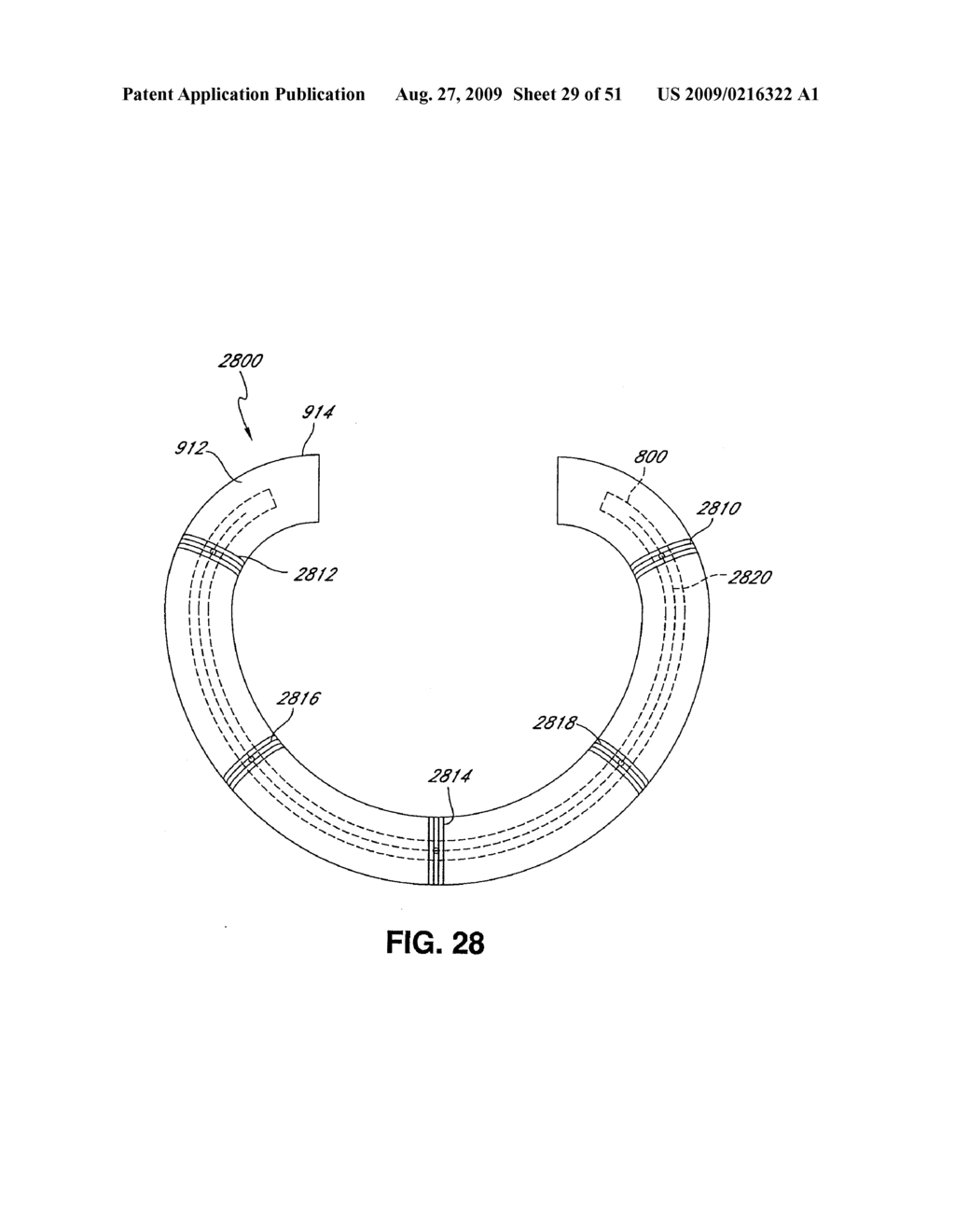 ADJUSTABLE ANNULOPLASTY RING AND ACTIVATION SYSTEM - diagram, schematic, and image 30