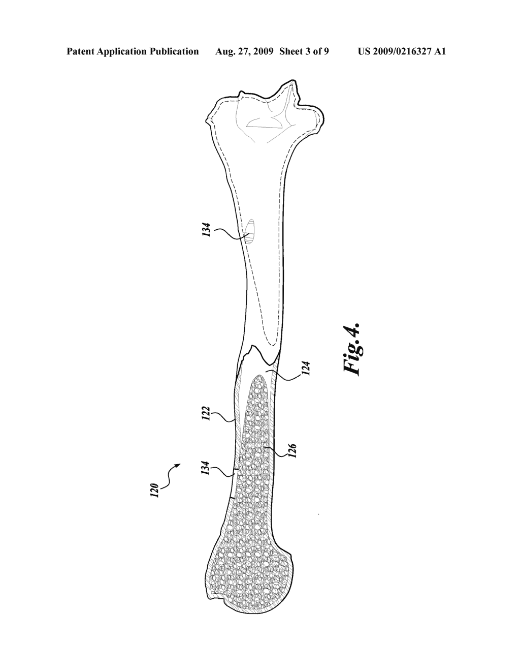 ARTIFICIAL BONES AND METHODS OF MAKING SAME - diagram, schematic, and image 04