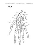 WRIST IMPLANTS diagram and image