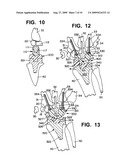 WRIST IMPLANTS diagram and image