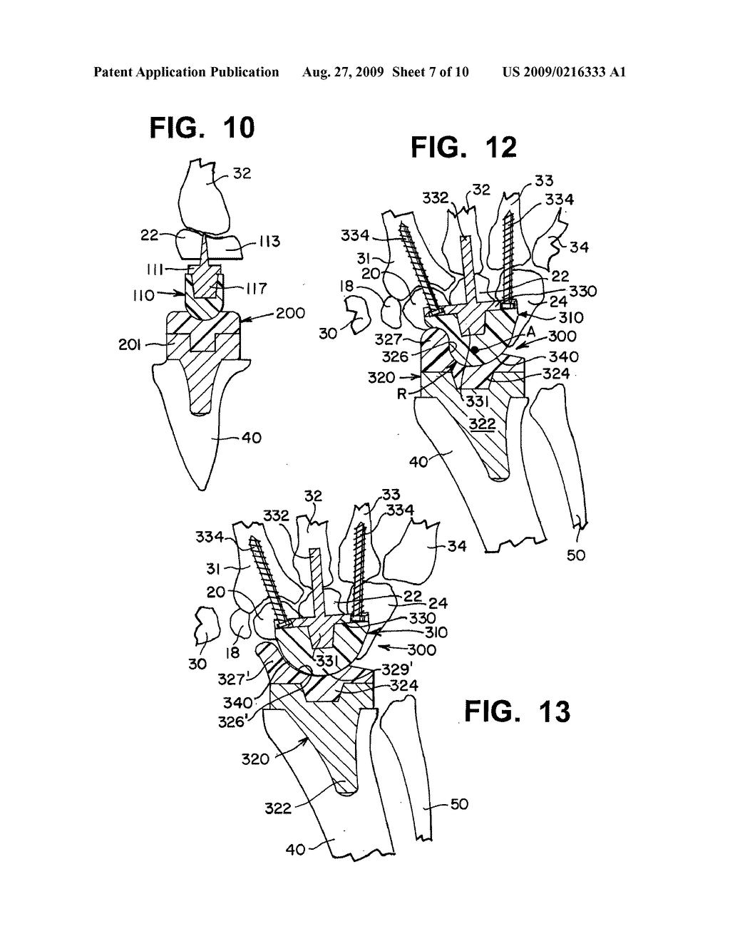 WRIST IMPLANTS - diagram, schematic, and image 08