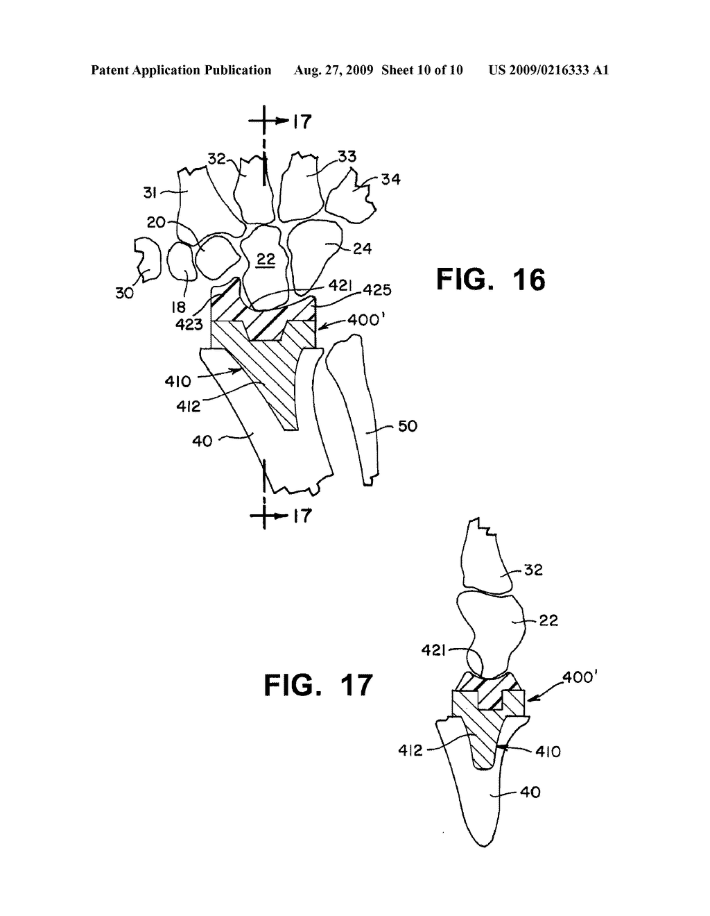 WRIST IMPLANTS - diagram, schematic, and image 11