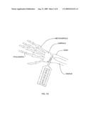 Bone Implants diagram and image