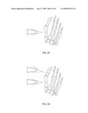 Bone Implants diagram and image