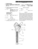 Femoral Hip Prosthesis and Method of Implantation diagram and image