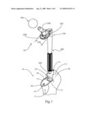 Femoral Hip Prosthesis and Method of Implantation diagram and image