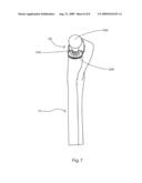 Femoral Hip Prosthesis and Method of Implantation diagram and image