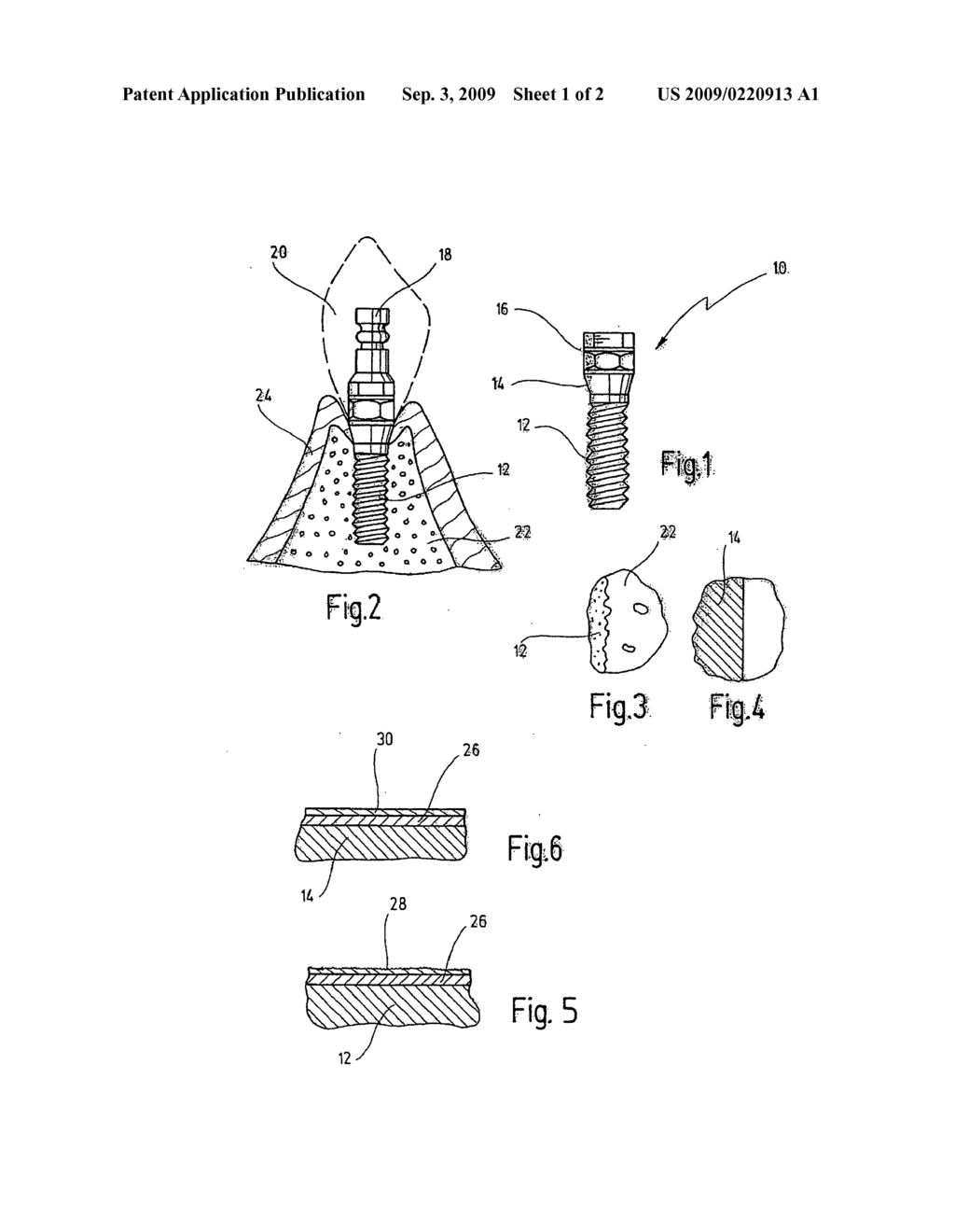 Enossal Implant Comprising an Anatase Coating - diagram, schematic, and image 02