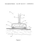 Method and Apparatus for Treatment of Adipose Tissue diagram and image