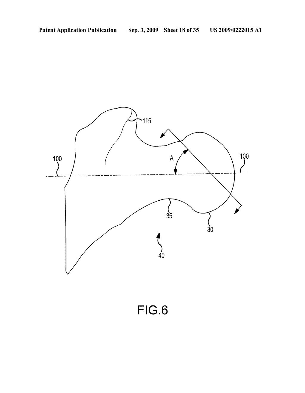 HIP RESURFACING SURGICAL GUIDE TOOL - diagram, schematic, and image 19