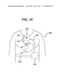 Physiological Parameter Analysis for an Implantable Restriction Device and a Data Logger diagram and image