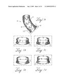 Prosthesis for Implantation in Aorta and Method of Using Same diagram and image