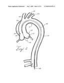 Prosthesis for Implantation in Aorta and Method of Using Same diagram and image