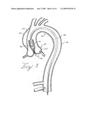 Prosthesis for Implantation in Aorta and Method of Using Same diagram and image