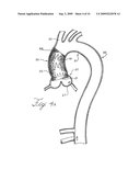 Prosthesis for Implantation in Aorta and Method of Using Same diagram and image