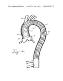 Prosthesis for Implantation in Aorta and Method of Using Same diagram and image