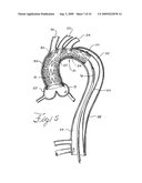 Prosthesis for Implantation in Aorta and Method of Using Same diagram and image