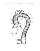 Prosthesis for Implantation in Aorta and Method of Using Same diagram and image