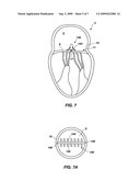 METHODS AND APPARATUS FOR REDUCING VALVE PROLAPSE diagram and image