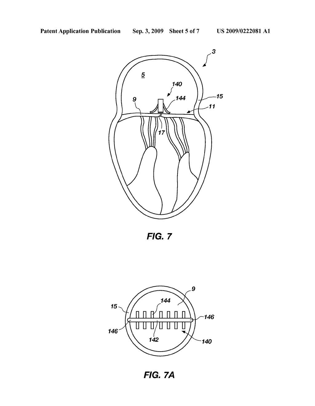 METHODS AND APPARATUS FOR REDUCING VALVE PROLAPSE - diagram, schematic, and image 06