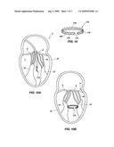 METHODS AND APPARATUS FOR REDUCING VALVE PROLAPSE diagram and image