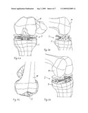 LIGAMENT-TENSIONING DEVICE diagram and image