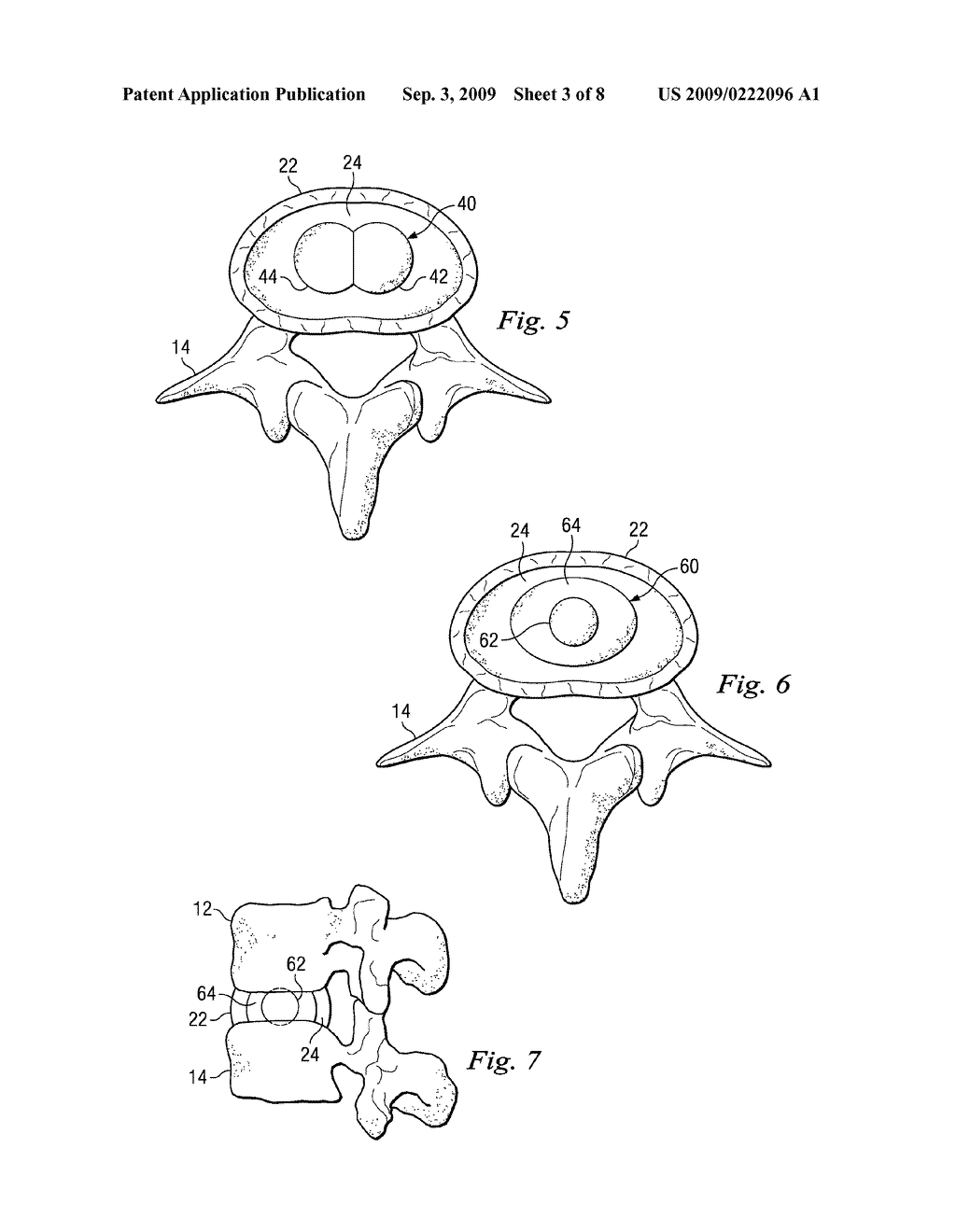 MULTI-COMPARTMENT EXPANDABLE DEVICES AND METHODS FOR INTERVERTEBRAL DISC EXPANSION AND AUGMENTATION - diagram, schematic, and image 04