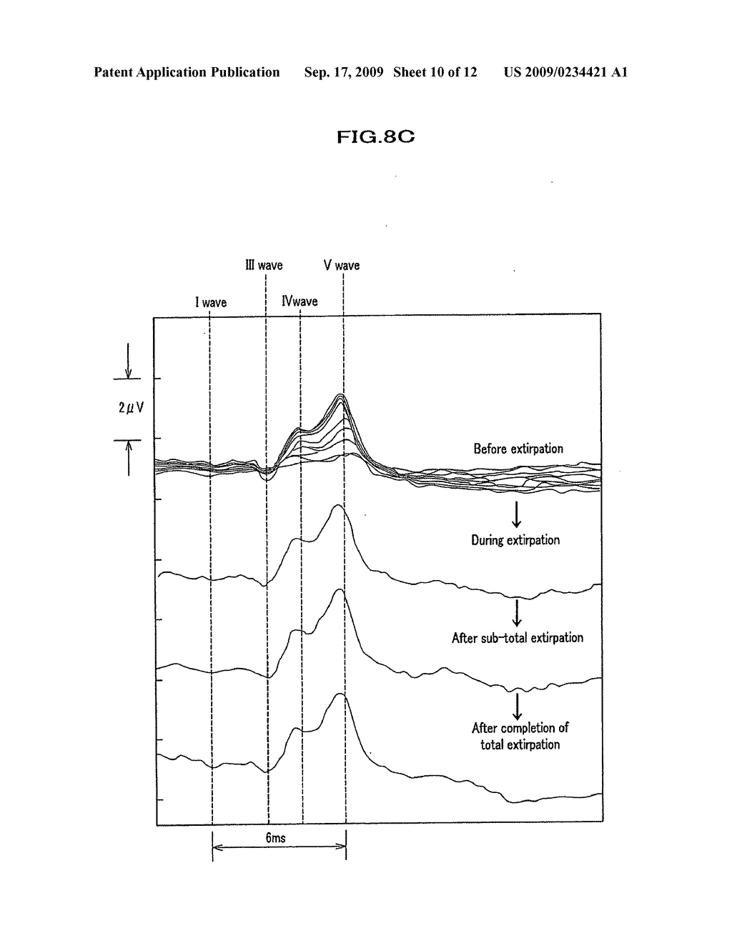 Monitoring electrode for monitoring dorsal cochlear nucleus action potentials and monitoring device for monitoring dorsal cochlear nucleus action potentials - diagram, schematic, and image 11