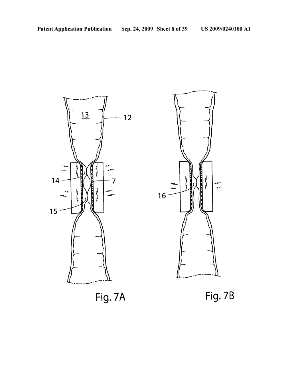 Method for controlling flow of intestinal contents in a patient's intestines - diagram, schematic, and image 09