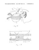 Apparatus and method for repairing vaginal reconstruction diagram and image