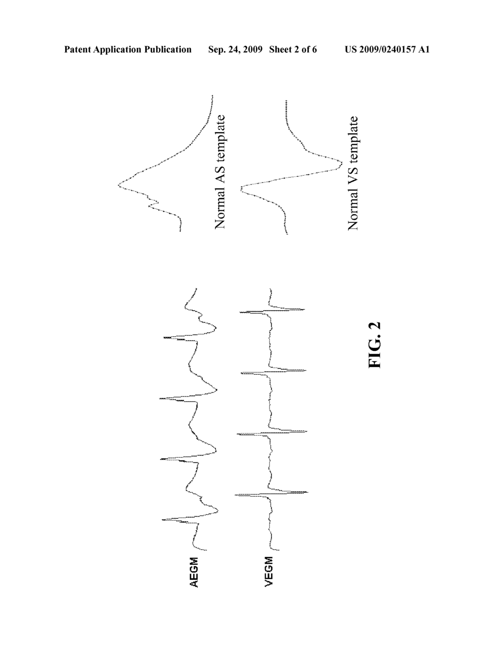 DEVICE, METHOD AND COMPUTER-READABLE STORAGE MEDIUM FOR ENHANCED SENSE EVENT CLASSIFICATION IN IMPLANTABLE DEVICES BY MEANS OF MORPHOLOGY ANALYSIS - diagram, schematic, and image 03