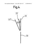 JOINT IMPLANT PLACEMENT diagram and image