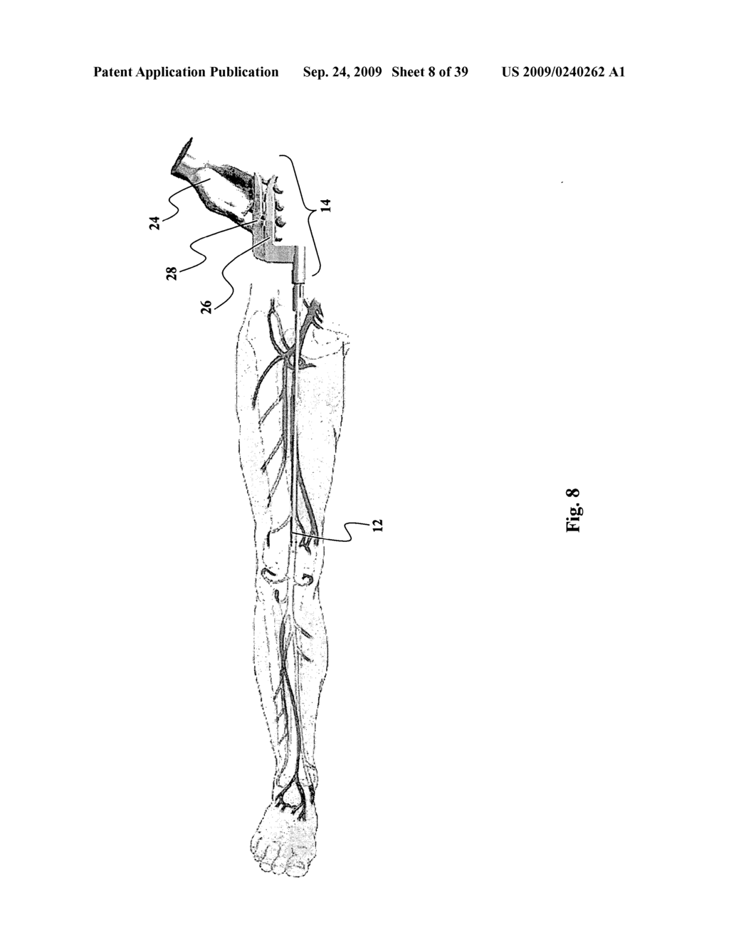 Device for affixing prosthesis to a vessel - diagram, schematic, and image 09