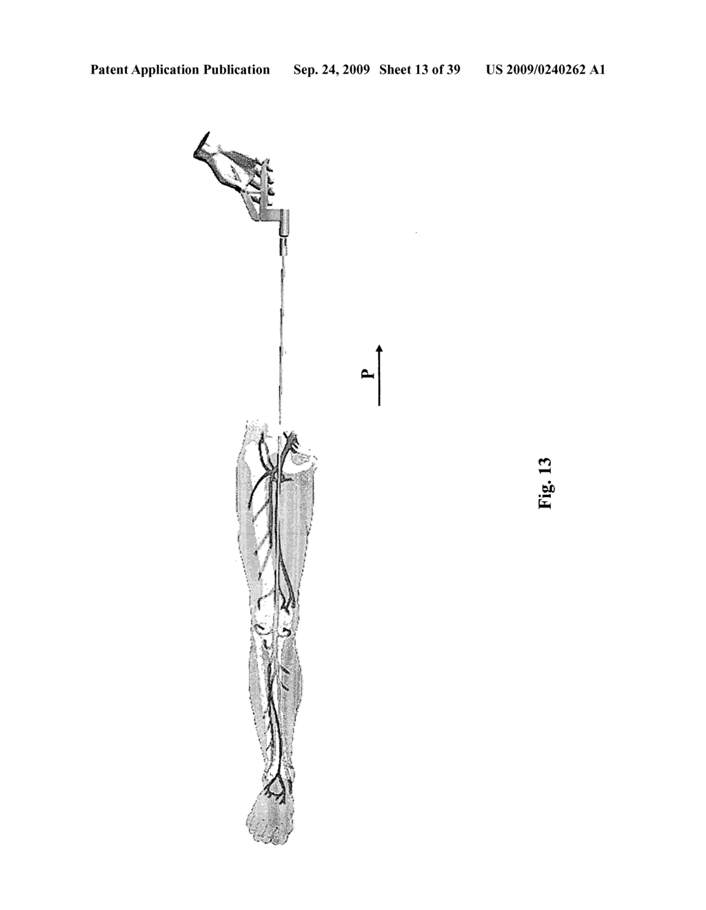 Device for affixing prosthesis to a vessel - diagram, schematic, and image 14