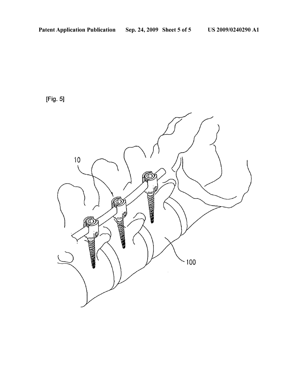 Buffer type vertebral pedicle screw - diagram, schematic, and image 06