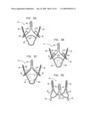 VALVE SUTURING AND IMPLANTATION PROCEDURES diagram and image