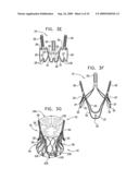 VALVE SUTURING AND IMPLANTATION PROCEDURES diagram and image