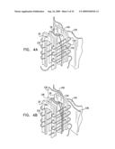 VALVE SUTURING AND IMPLANTATION PROCEDURES diagram and image